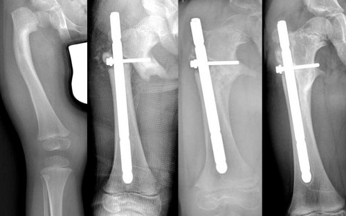 Deformation of femur 