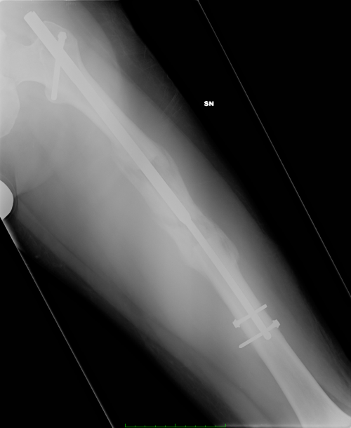 Xrays of fused bone