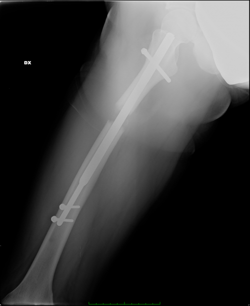 Xrays during lengthening