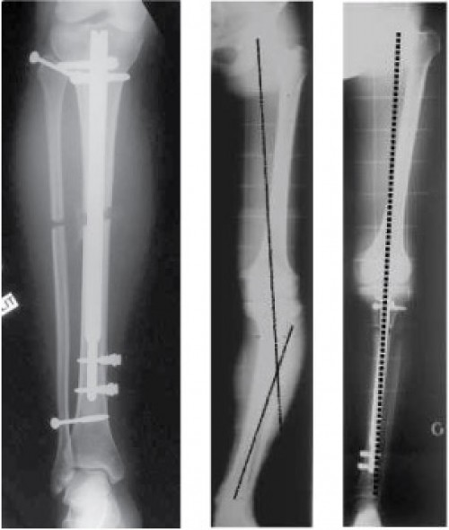 tibia