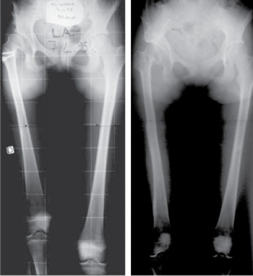 The hip maybe unstable (defect of coverage of the hip), requiring surgery to cover and protect the hip