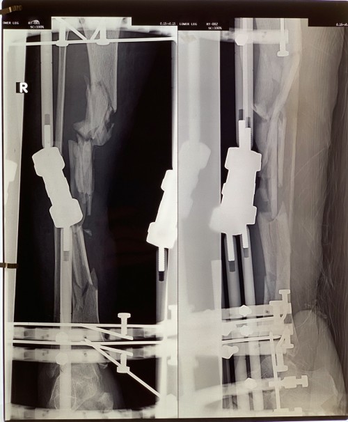 Xrays with external fixator