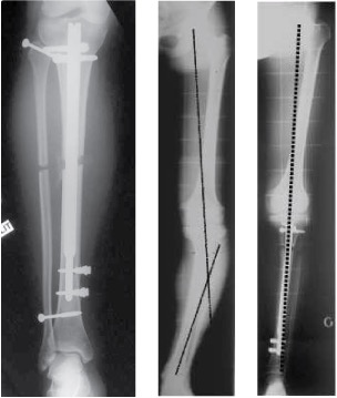 tibia tibia