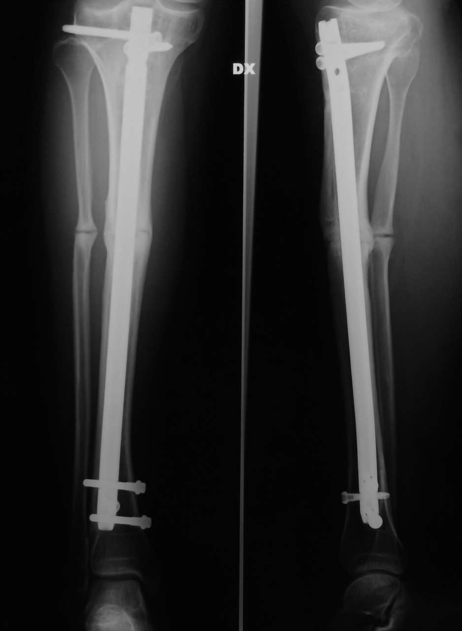 tibia2 tibia2